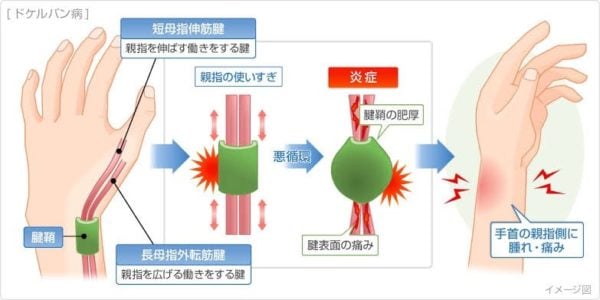 腱鞘炎図解